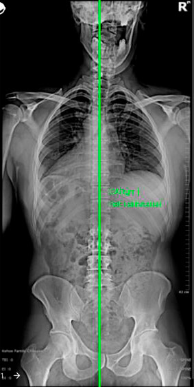 Fig. 2 – Equilíbrio coronal