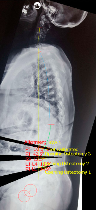 Fig. 6 – Pós-op (balanço neutro)